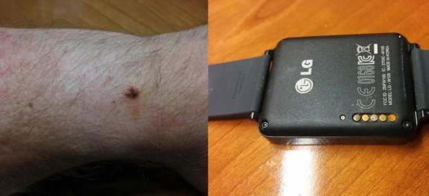 LG G Watchで火傷や充電端子が腐食する不具合が報告される、対策方法など
